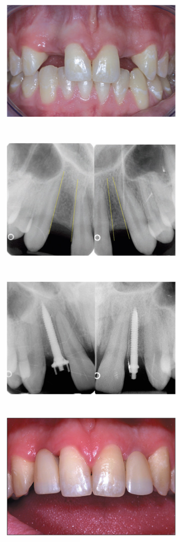 Implant étroit ANEW de Dentatus