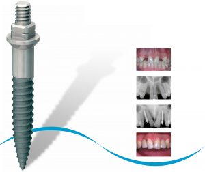 Implant étroit ANEW de Dentatus